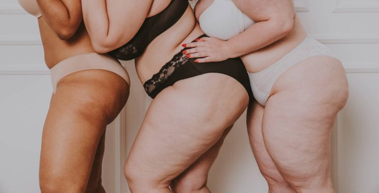 Das Lipödem: So erkennen und behandeln Sie die Fettstörung - Beuthel